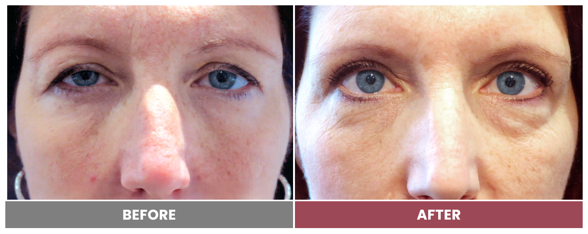 BLEPHAROPLASTY & PTOSIS REPAIR - Case 5